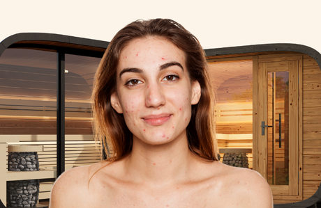 Saunas for Eczema & Psoriasis: When Heat Helps and When It Hurts